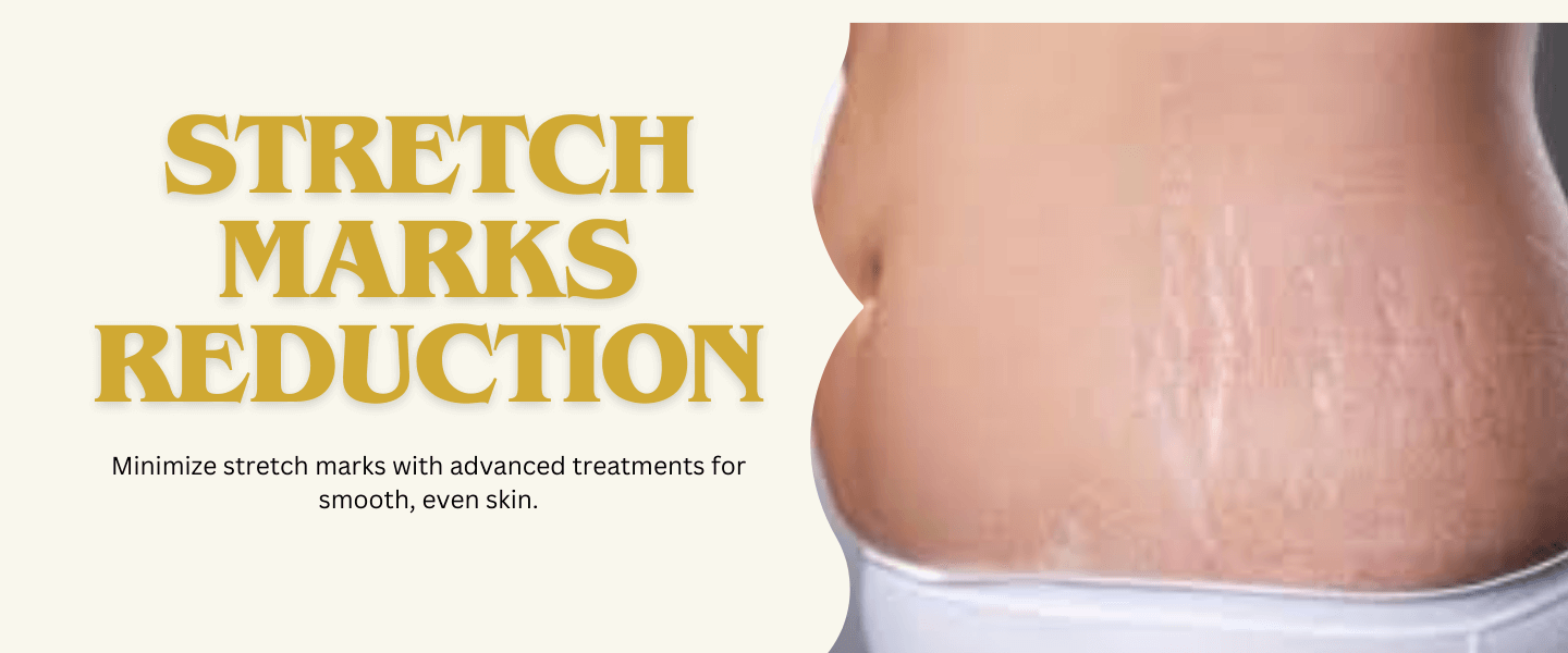 Stretch Marks Reduction